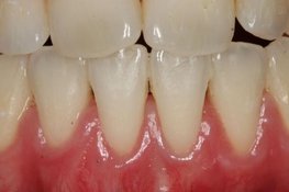 Uitnodiging lezing 18 november: Een recessie is vaak meer dan alleen ‘te weinig gingiva’.