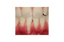 Uitnodiging lezing 18 november: Een recessie is vaak meer dan alleen ‘te weinig gingiva’.
